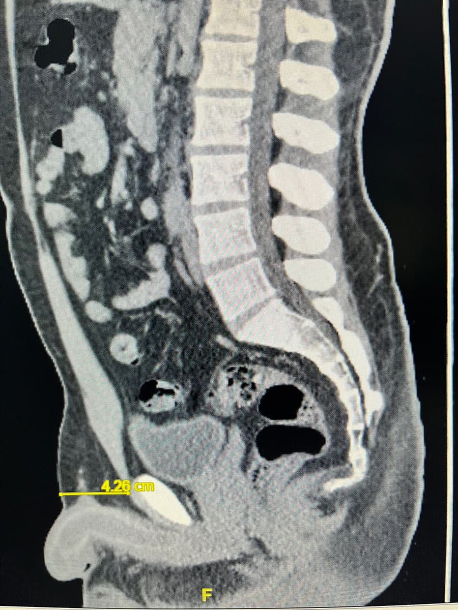 Image of man with large fat pads