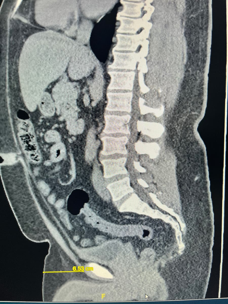 Image of man with 4.26 cm (1.7 inches) fat pads