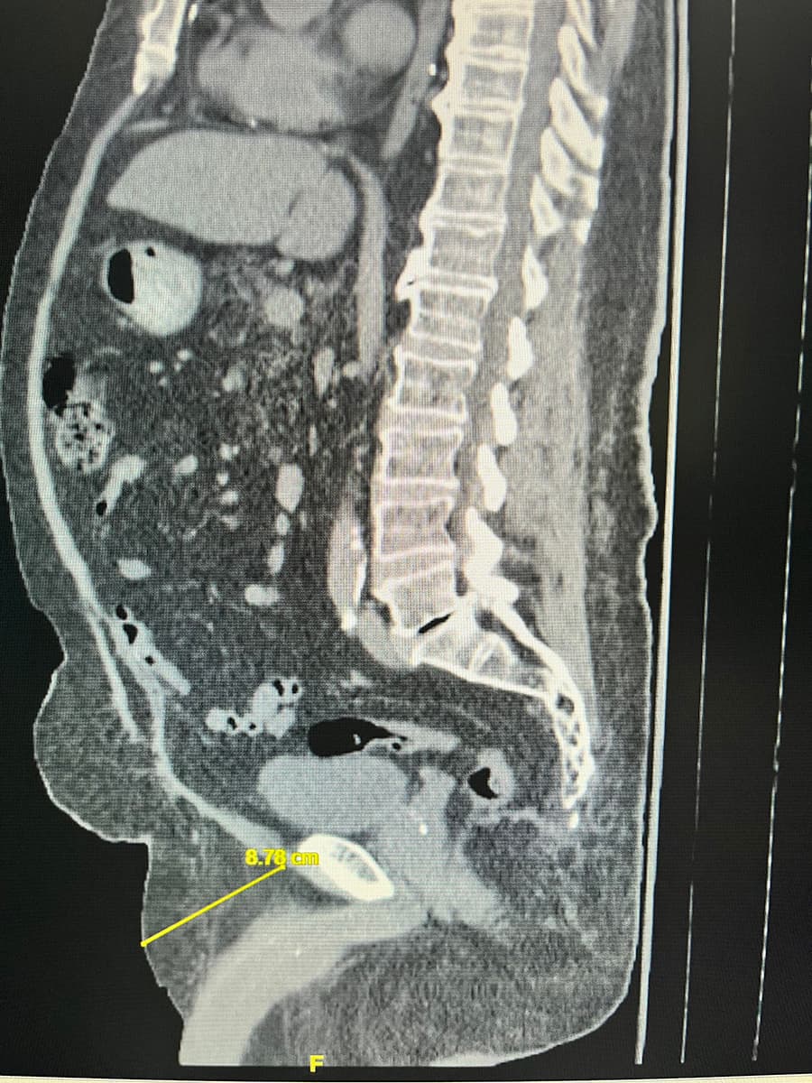 Image of man with 8.78 cm (3.5 inches) fat pads