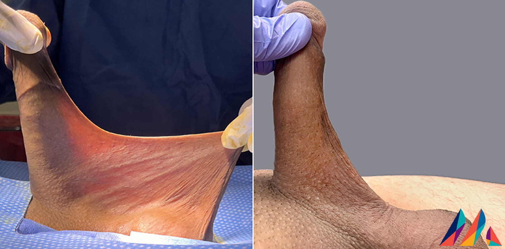 Penoscrotal Web Before & After Image