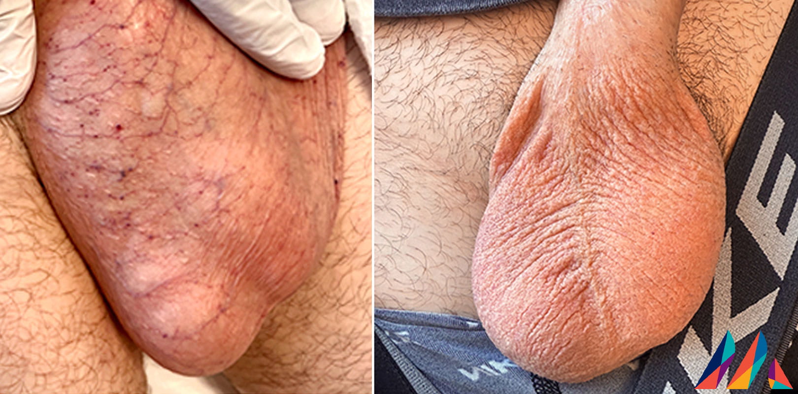 Scrotal Angiokeratoma Before & After Image