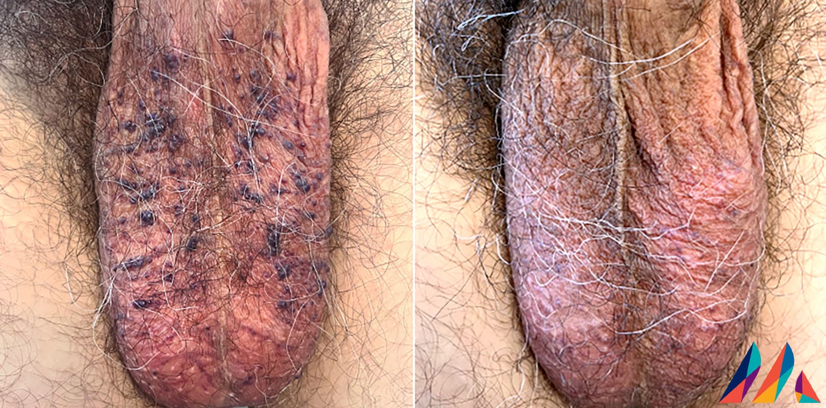 Scrotal Angiokeratoma Before & After Image